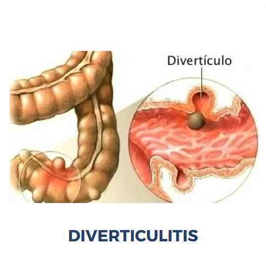 tratamiento a diverticulos